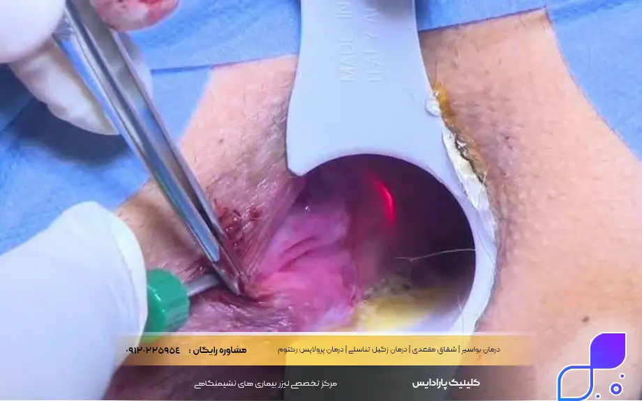 درمان لیزری شقاق مقعدی