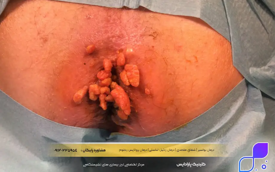 علائم زگیل تناسلی در زنان