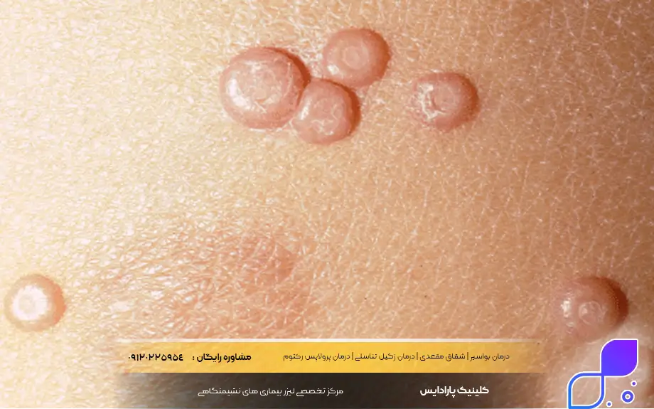 علائم زگیل تناسلی در زنان باردار