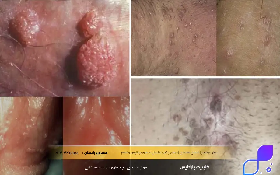 علائم زگیل تناسلی در زنان عکس