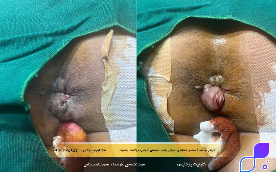 عکس قبل و بعد از لیزر بواسیر