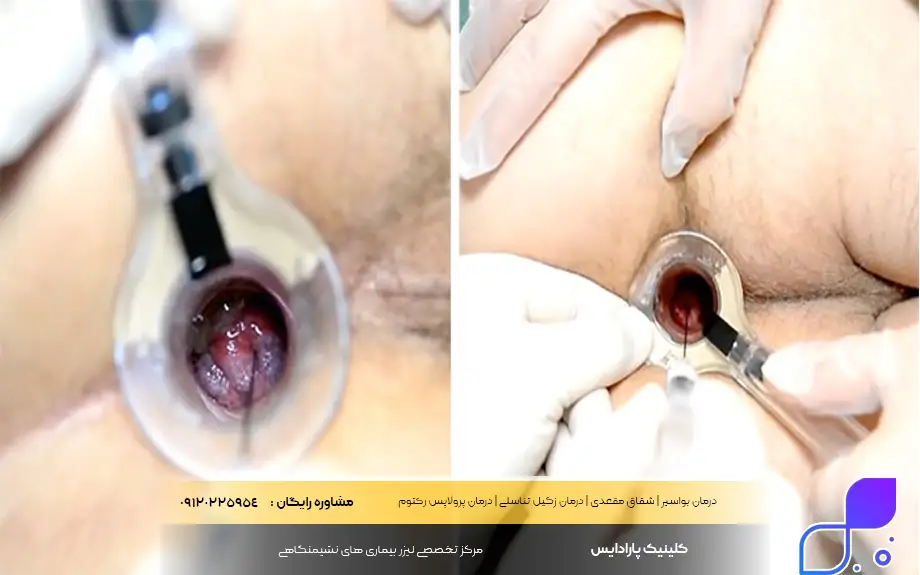 لیزر بواسیر