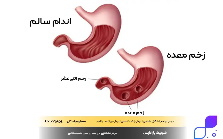 عوارض خطرناک زخم معده