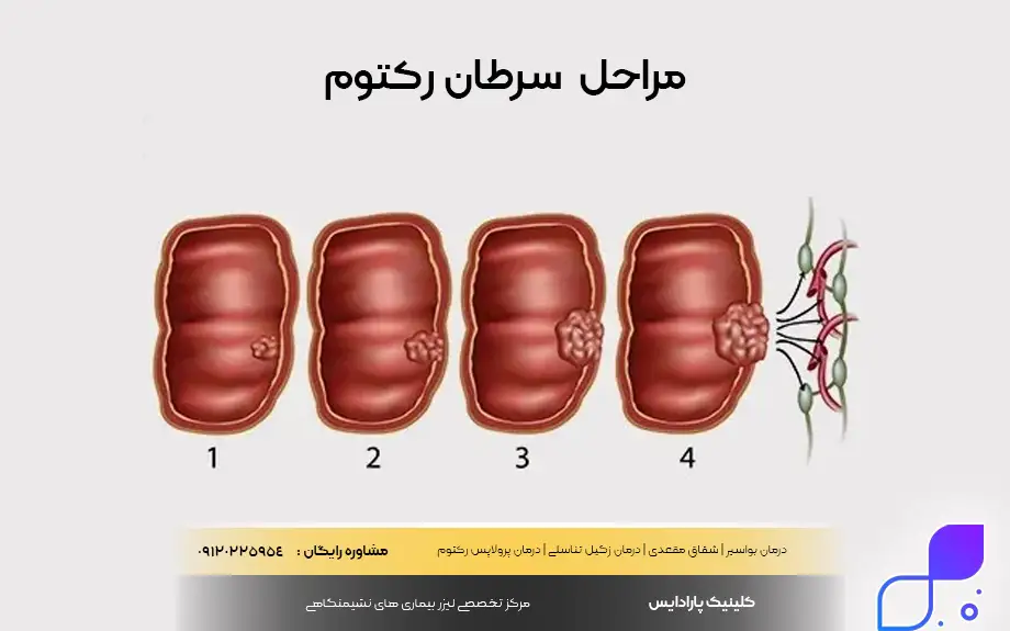 مراحل سرطان رکتوم 
