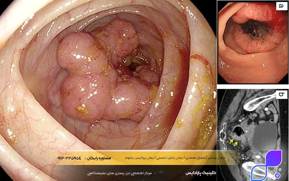عکس سرطان رکتوم