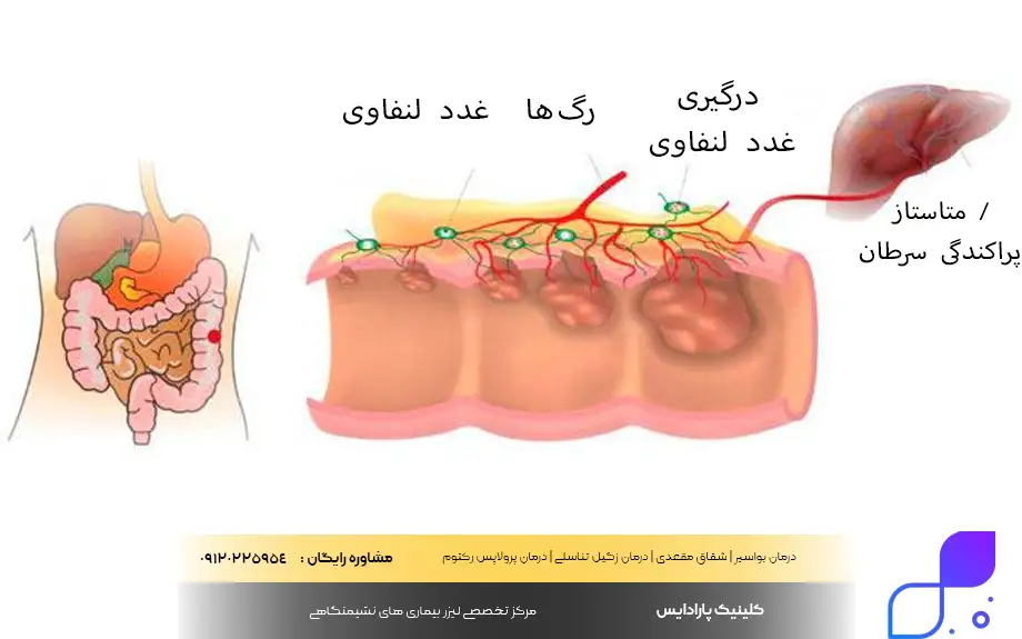 سرطان رکتوم