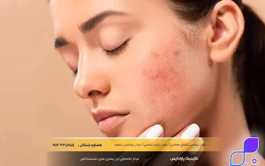 پماد زینک اکساید برای جوش