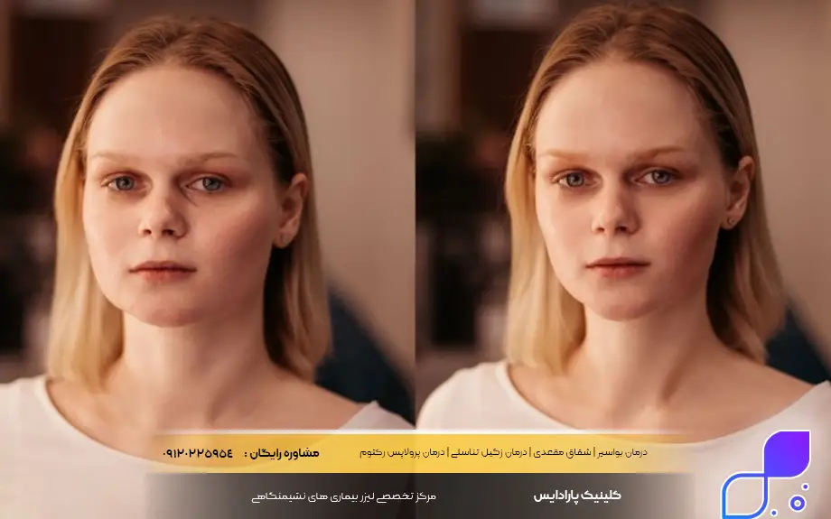 پماد زینک اکساید برای چاقی صورت