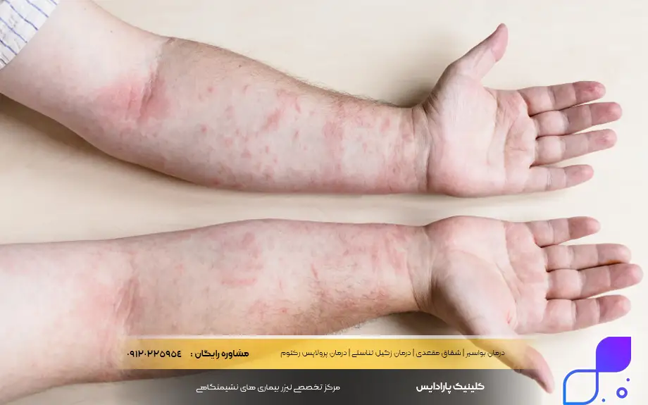 عوارض جانبی پماد زینک اکساید