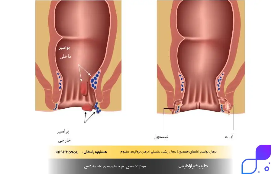 علت گشادی مقعدی