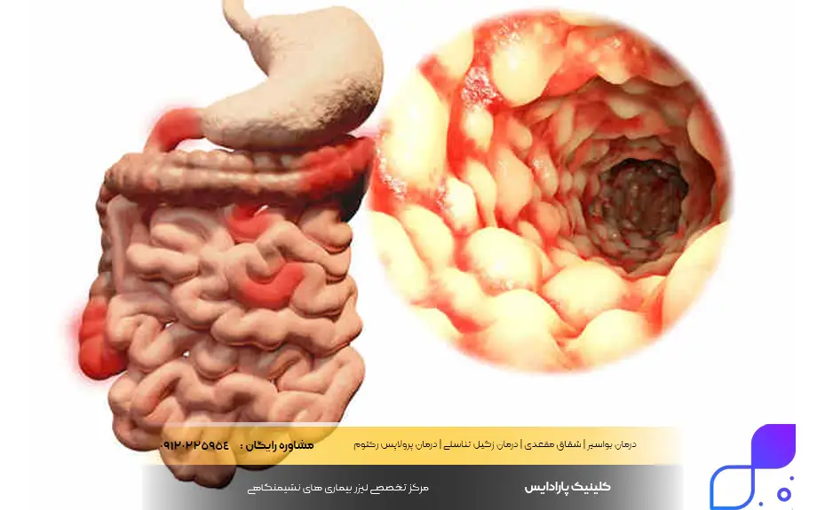 التهاب روده چیست