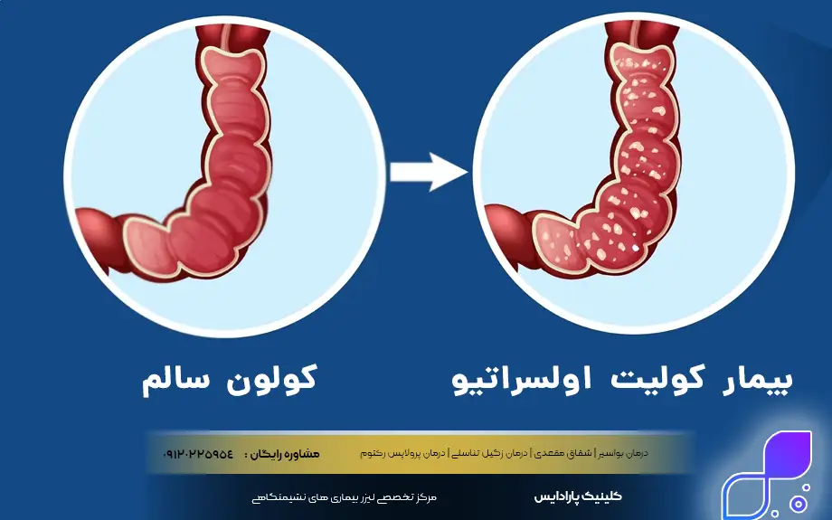 کولیت اولسراتیو و بیماری کرون