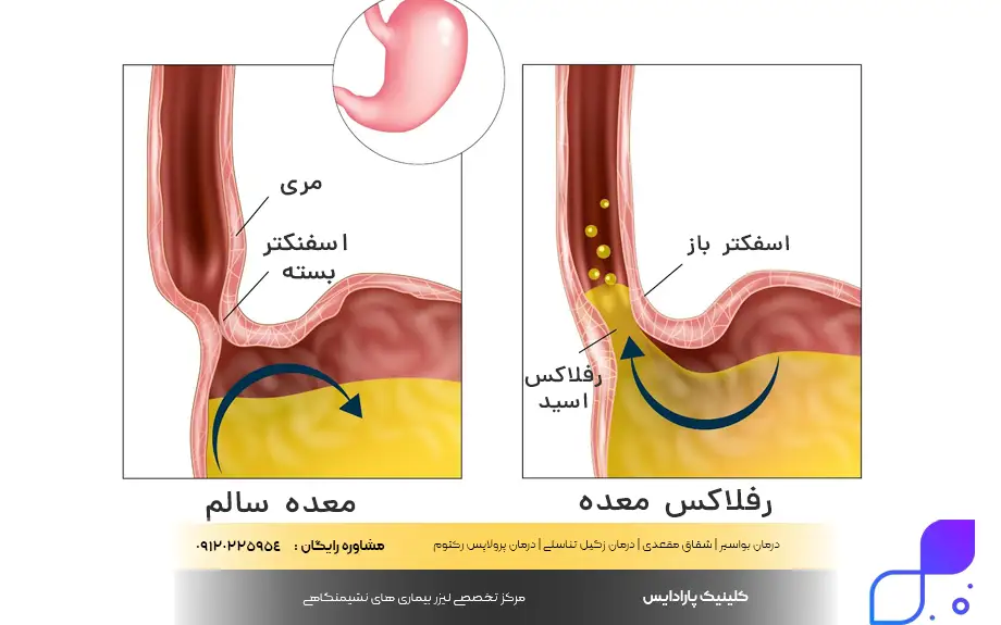 ترش کردن معده