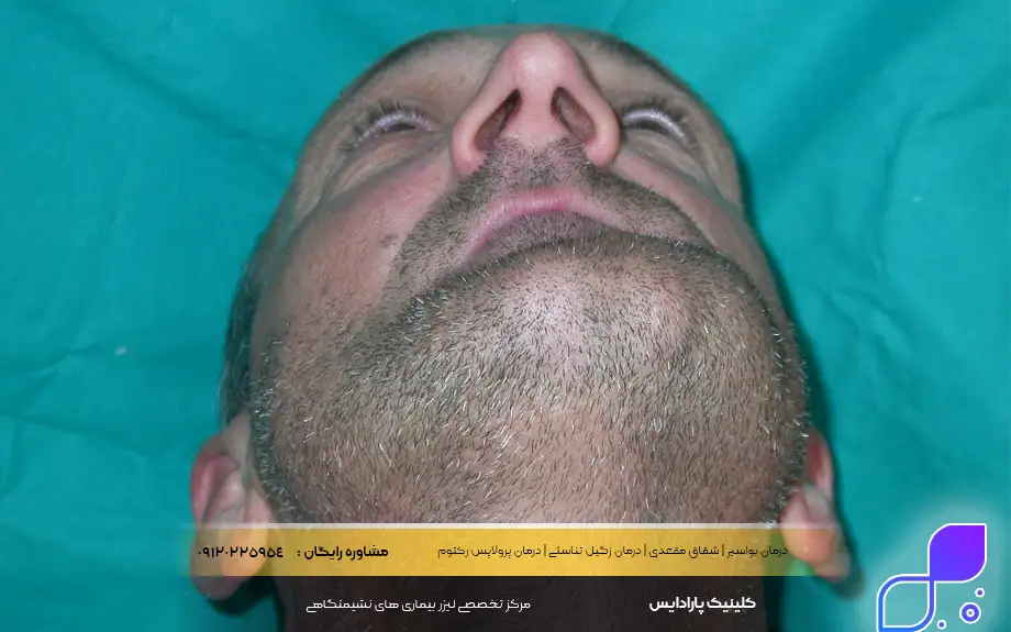 جراحی غده چربی در سر