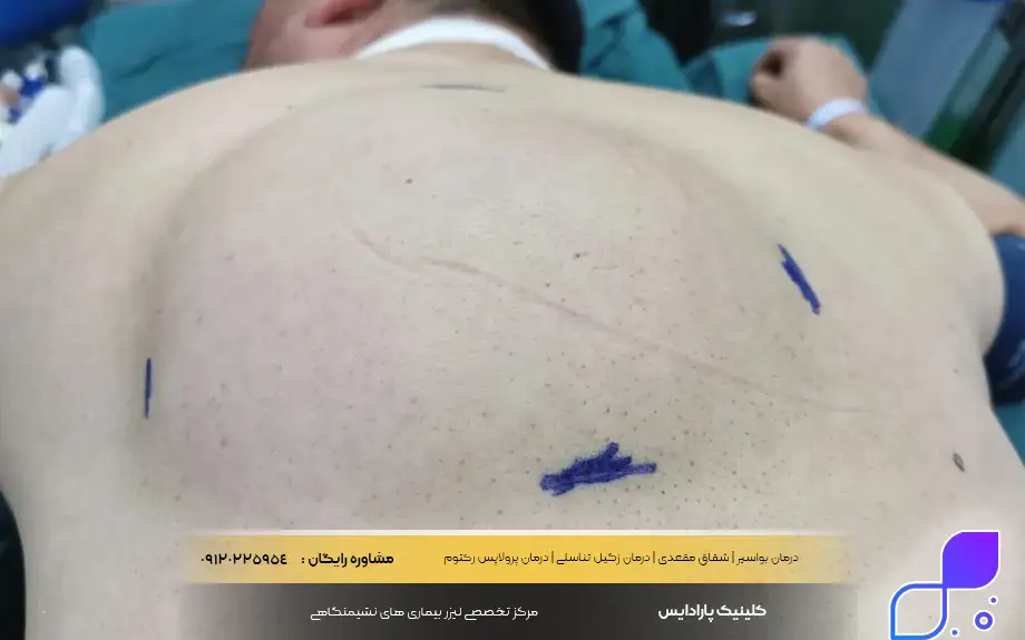 علائم لیپوم بدخیم