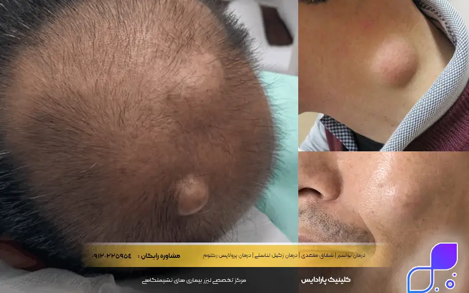 انواع لیپوم