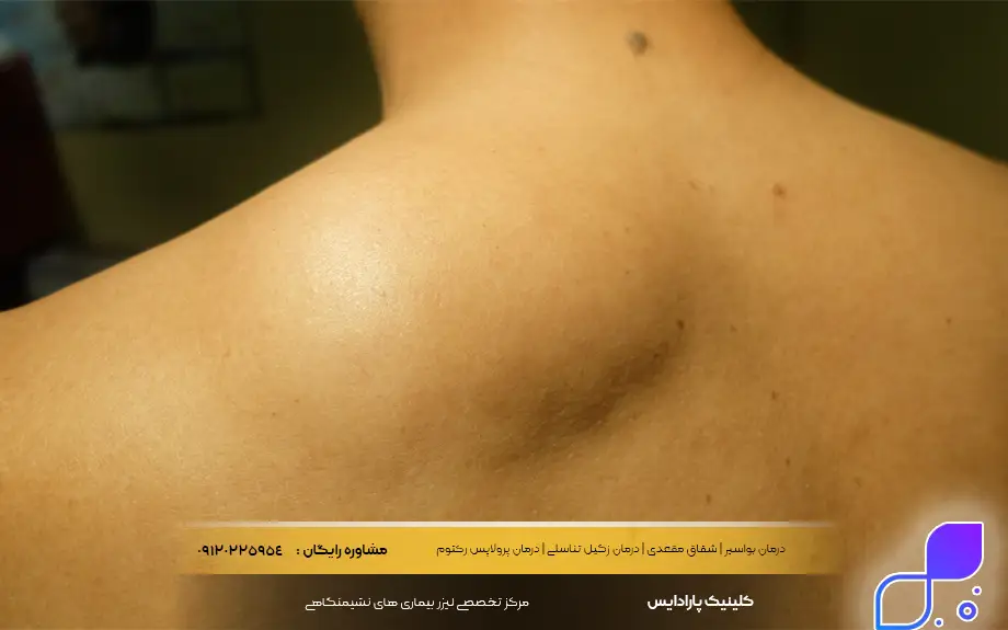 لیپوم بدخیم