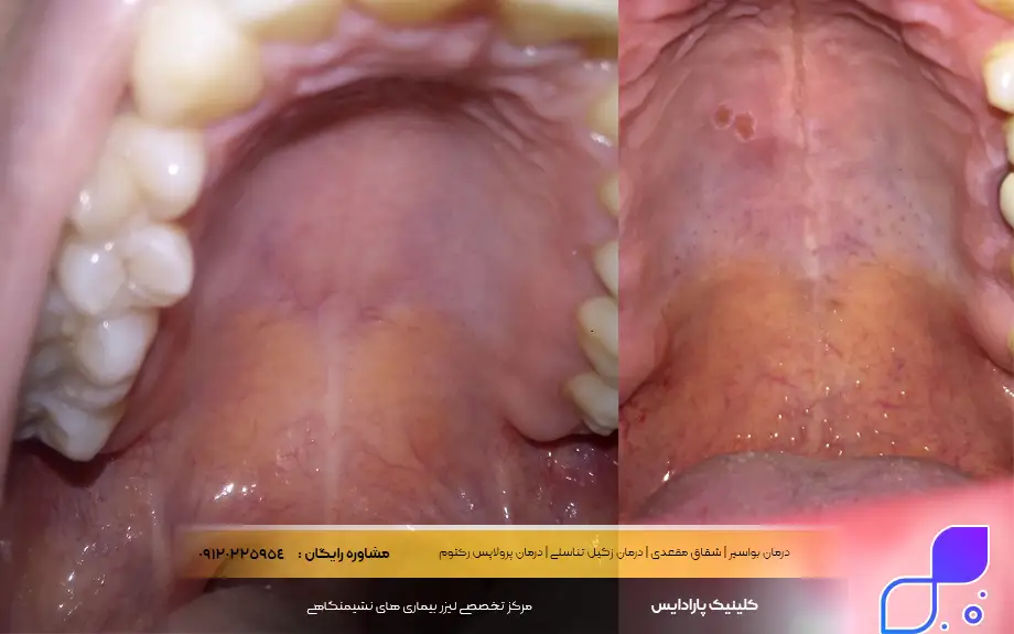 آنتی بیوتیک برای عفونت سقف دهان