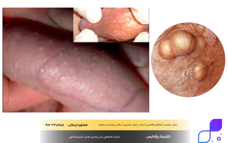 دانه های فوردایس در مردان