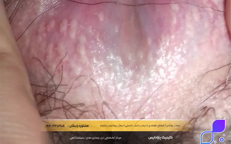 عکس دانه های فوردایس در زنان