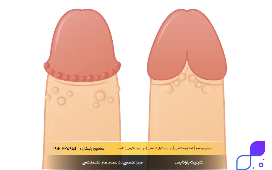 فوردایس تناسلی