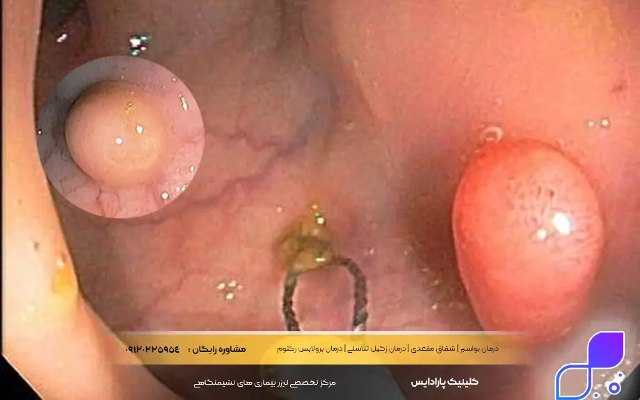 تصاویر سرطان مقعدی