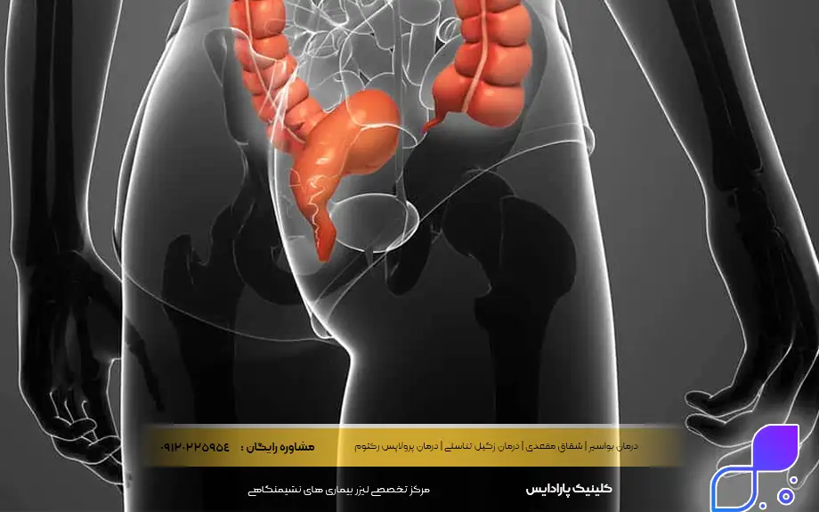 علائم سرطان مقعدی در زنان