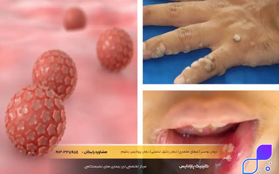 علت سرطان مقعدی چیست