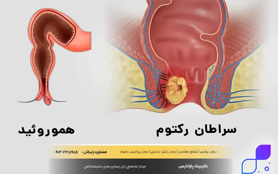 تفاوت بواسیر و سرطان مقعدی