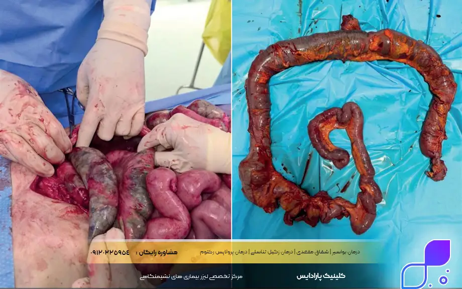 جراحی ایسکمی روده