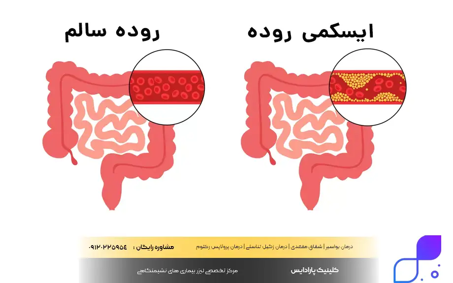 ایسکمی روده چیست