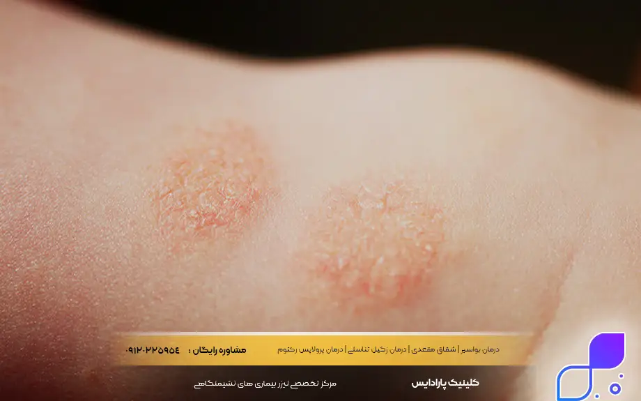 عکس پسوریازیس خفیف