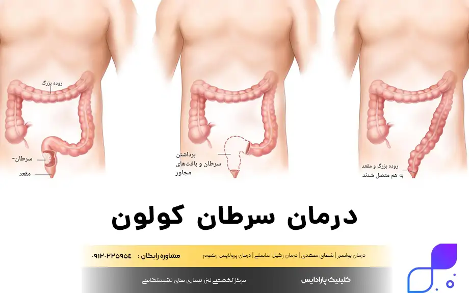 سرطان کولون درمان دارد