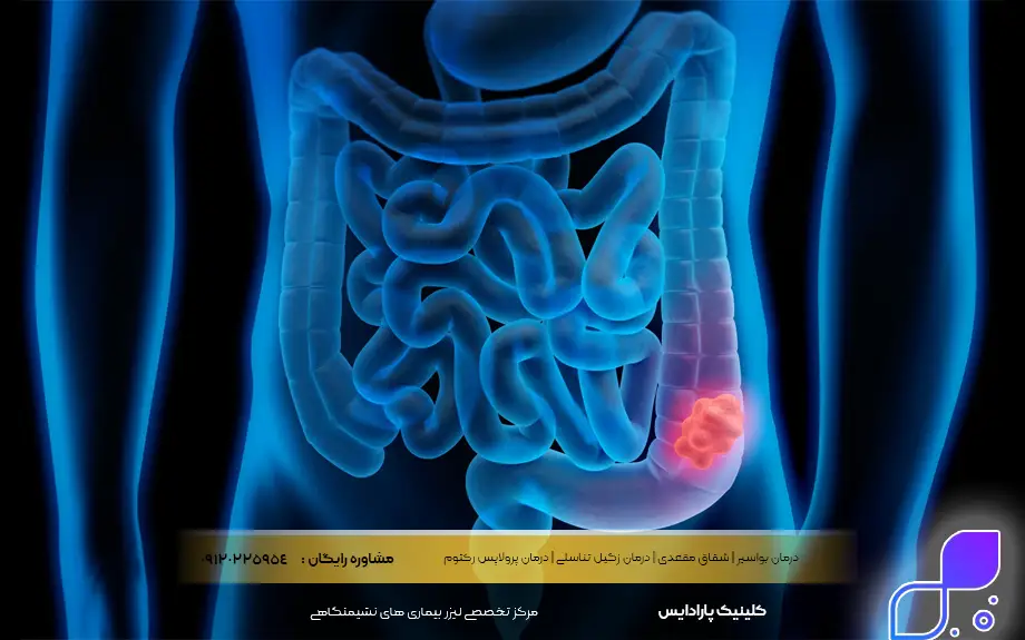 سرطان کولون