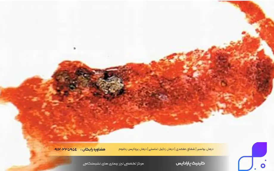 عکس اسهال خونی