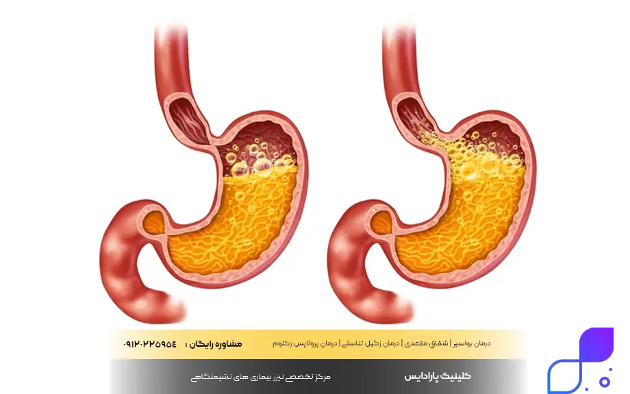 اسید معده چیست