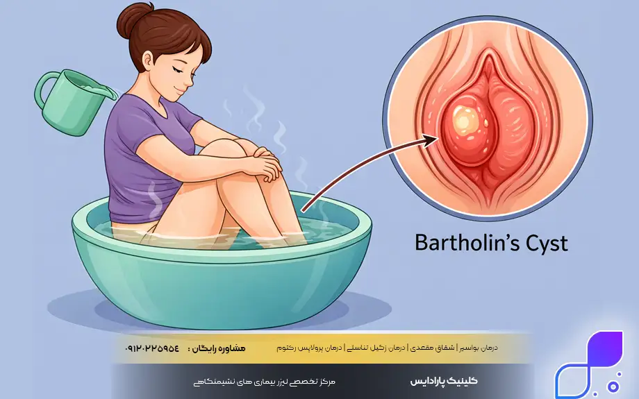 حمام سیتز برای کیست بارتولین