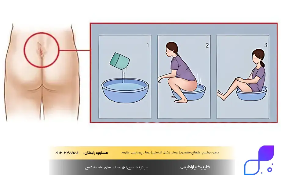 حمام سیتز برای کیست مویی