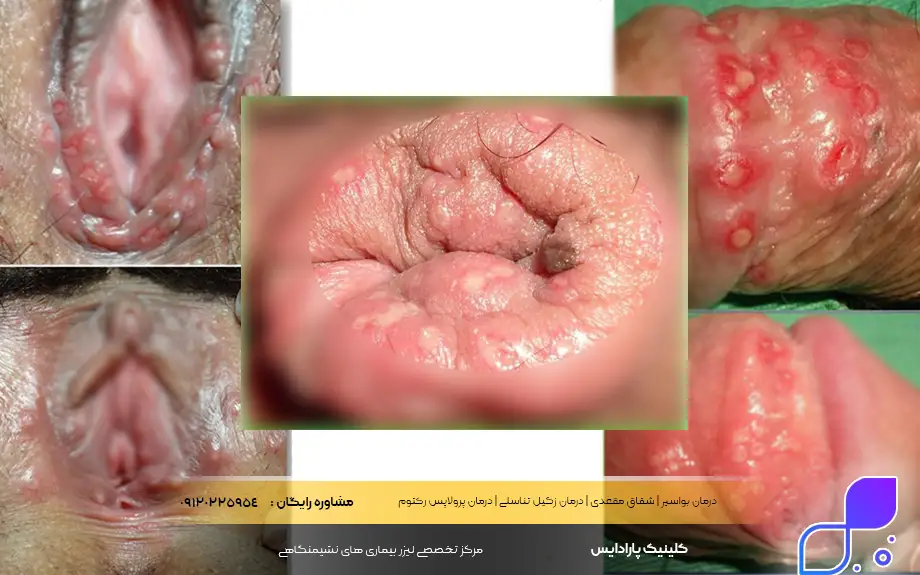 عکس تبخال تناسلی