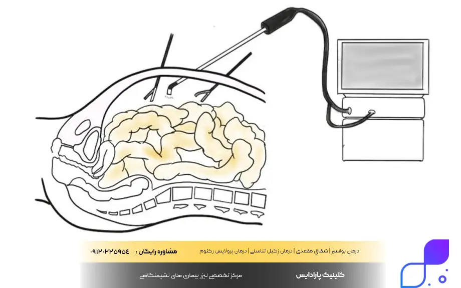 لاپاراسکوپی کیسه صفرا