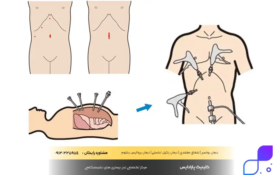 عمل لاپاراسکوپی در مردان