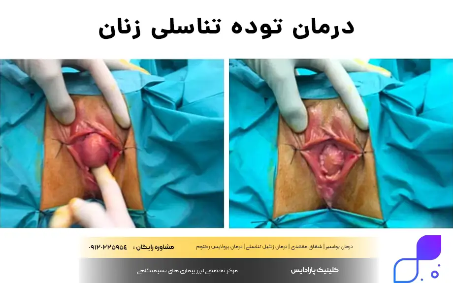 درمان توده تناسلی زنان