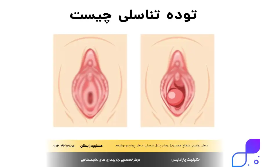 توده تناسلی چیست