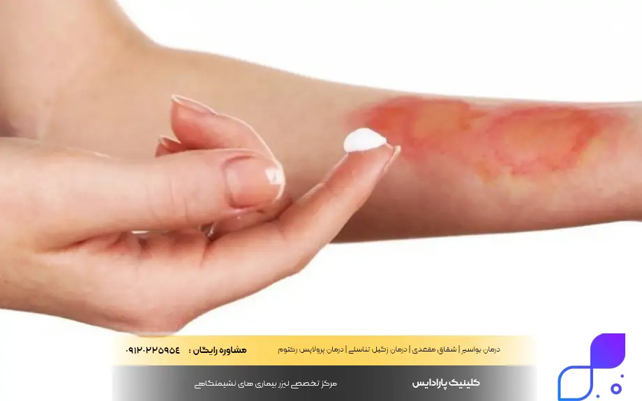 پماد موپیروسین برای سوختگی