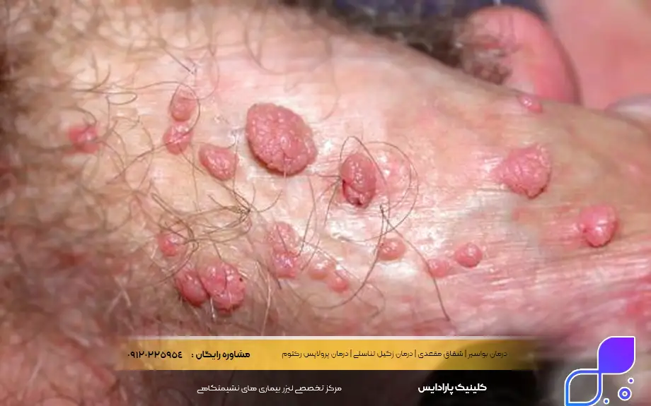 عکس زگیل تناسلی