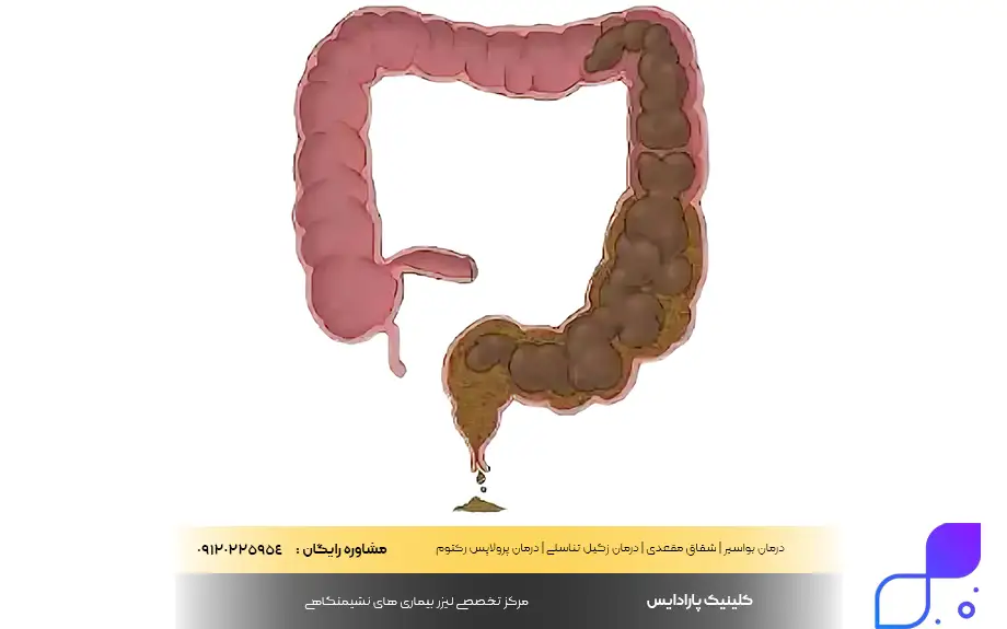 مدفوع خشک شده در روده