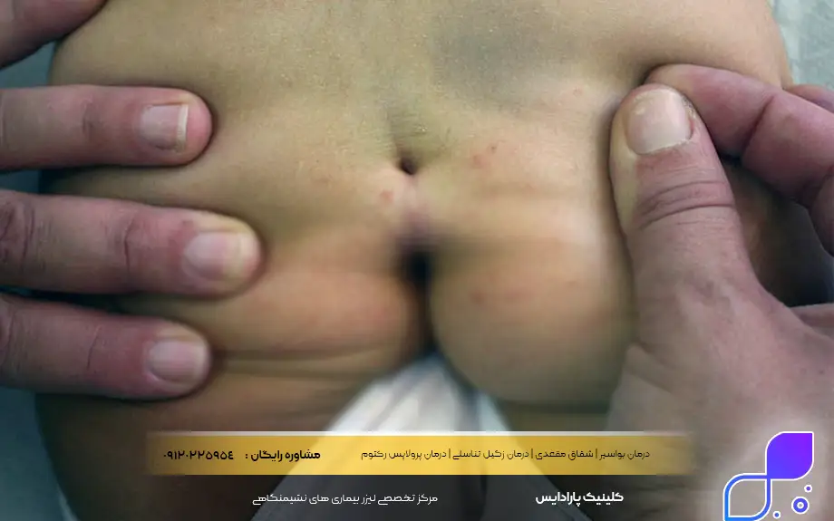 کیست مویی کمر