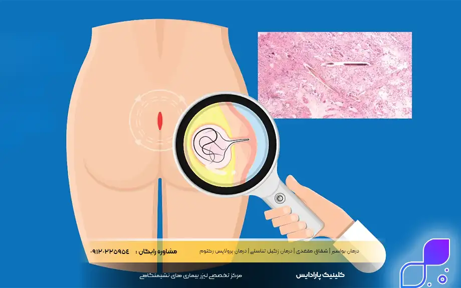 کیست مویی در زنان