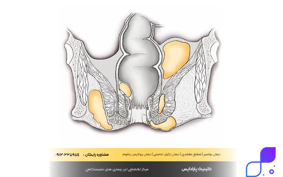 بیماری آبسه مقعدی