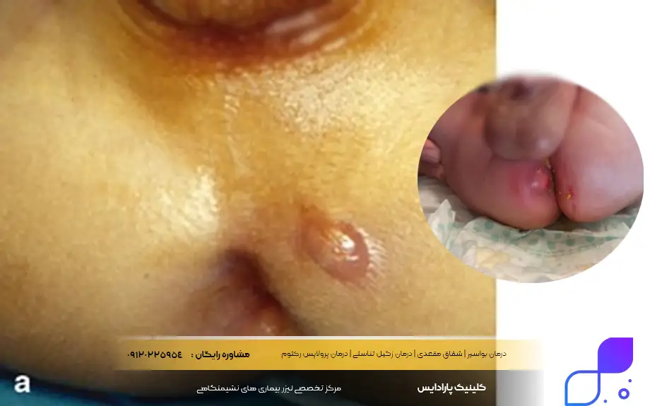 آبسه مقعدی در نوزادان